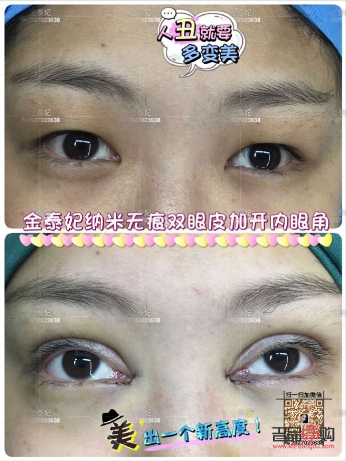 翹睫雙眼皮恢復全記錄：真實經歷與心路歷程