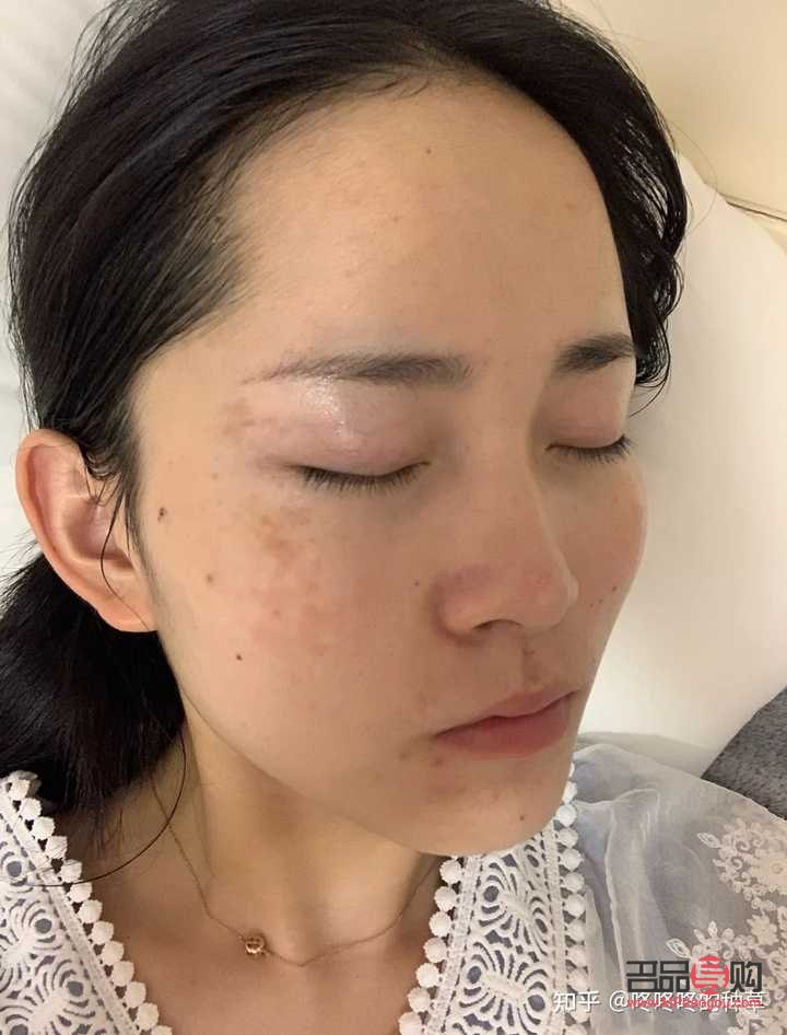 美容院祛雀斑效果好嗎？專(zhuān)業(yè)分析與建議