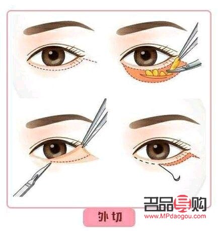 <h3>眼袋手術內切與外切：選擇哪個更合適？</h3>