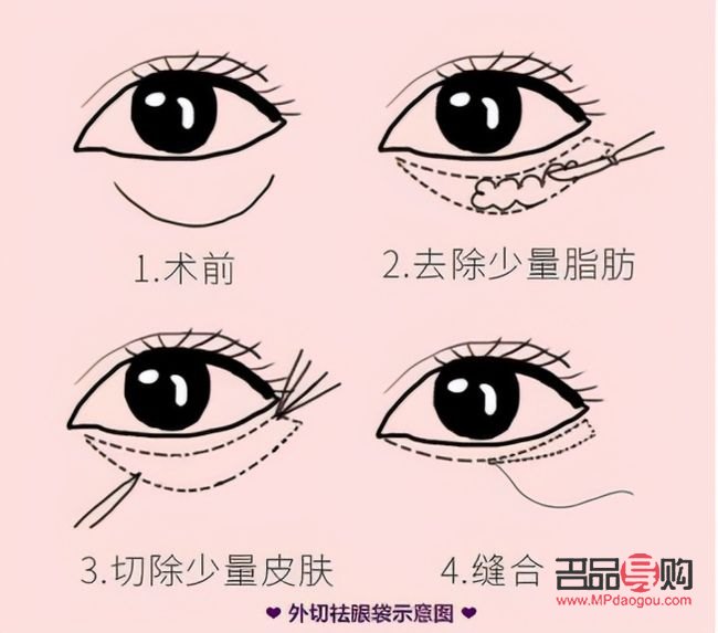 眼袋手術內切與外切：選擇哪個更合適？
