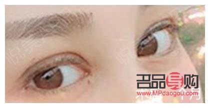 什么季節(jié)做雙眼皮好恢復(fù)(什么季節(jié)做雙眼皮好恢復(fù)快)