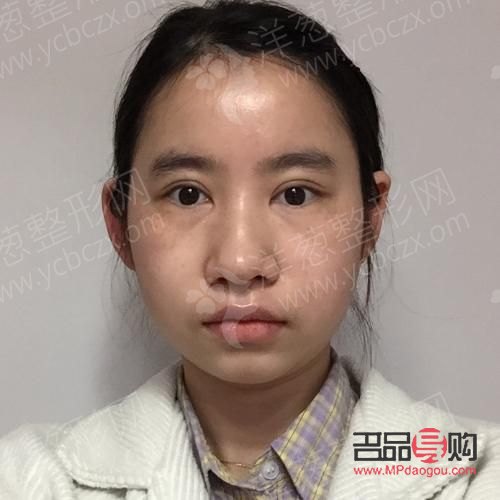 矯正眼睛一高一低，重塑自信面容