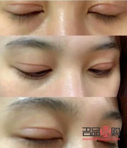 做了大綜合雙眼皮大概多久恢復好(做大綜合雙眼皮幾天能恢復)