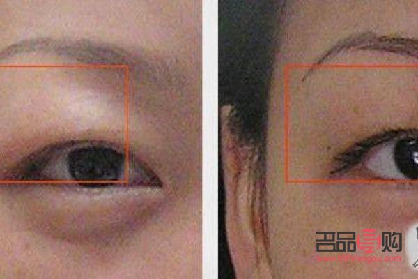 眼眶凹陷怎么恢復飽滿 中醫(yī)治療(眼眶凹陷怎么恢復飽滿 中醫(yī)治療方法)