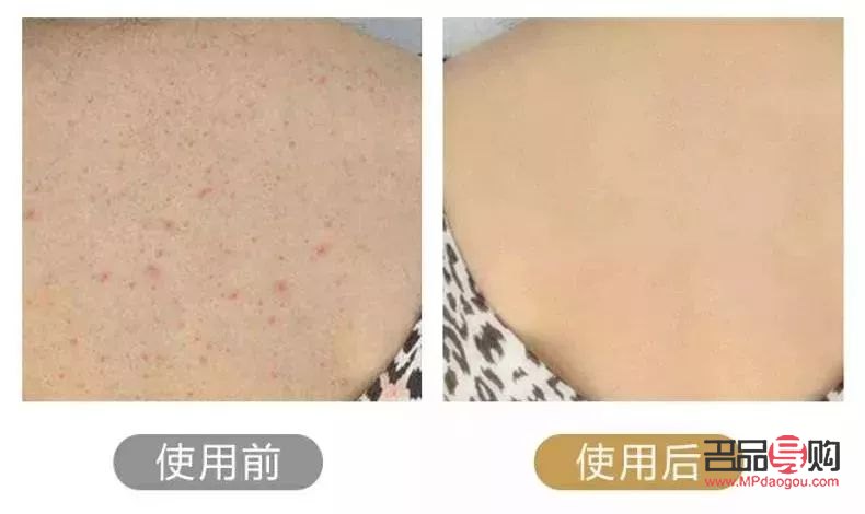 身體毛囊護理怎么做好(身體毛囊護理怎么做好呢)