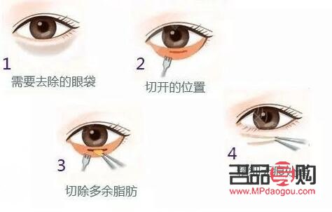 <h3>眼袋切除后是否還會再次生長？</h3>