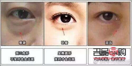 眼袋切除后是否還會再次生長？
