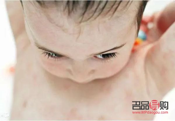 <h3>寶寶身體過敏，如何正確護理？</h3>