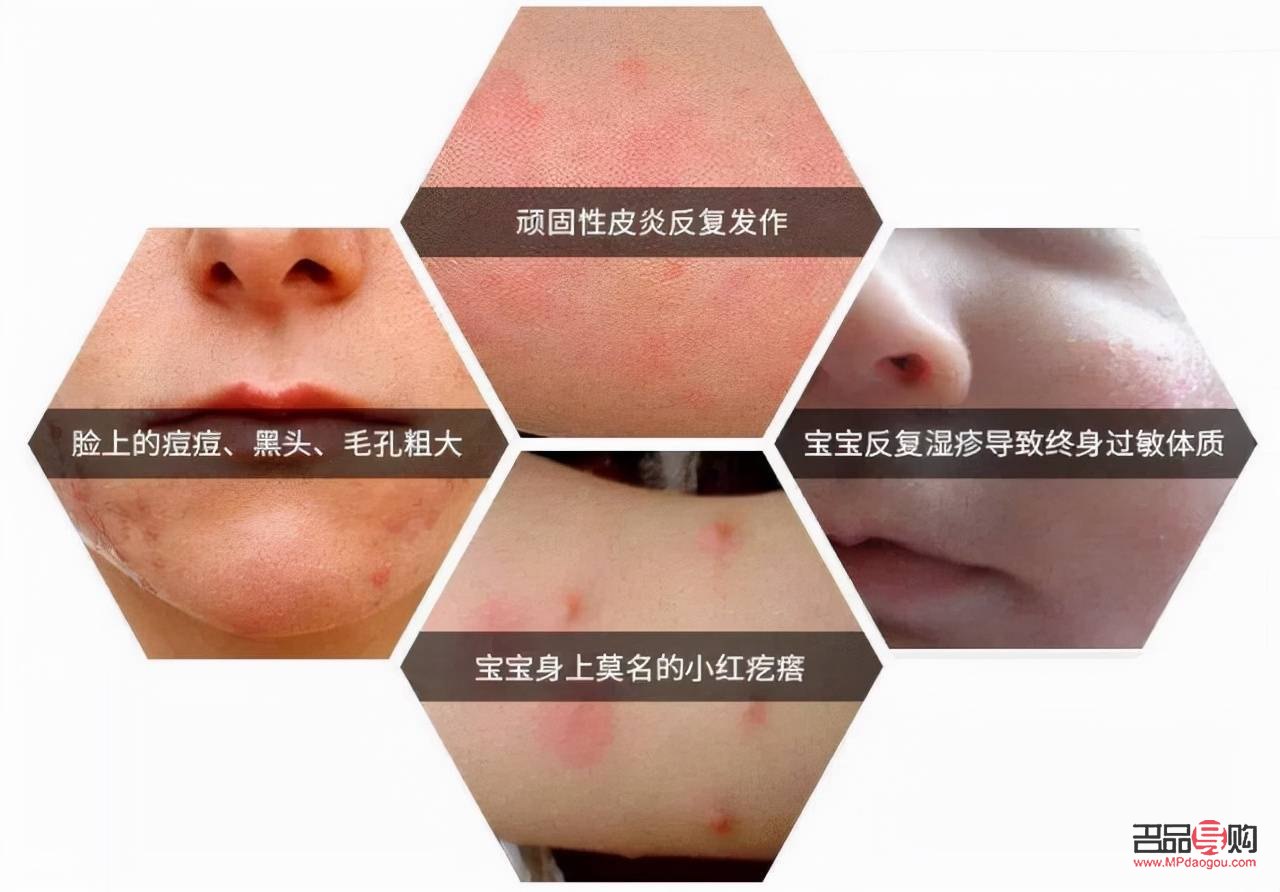 寶寶身體過敏，如何正確護理？