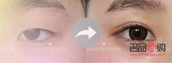 <h3>雙眼皮埋線手術效果能持續多久？</h3>