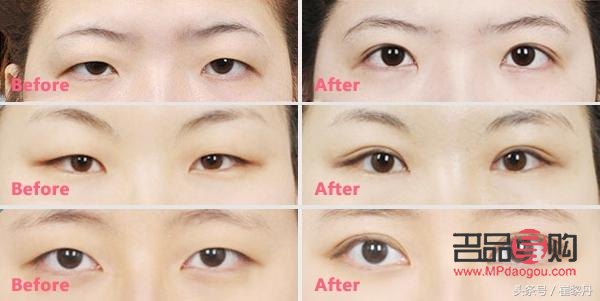 腫眼泡適合做什么樣的雙眼皮手術？