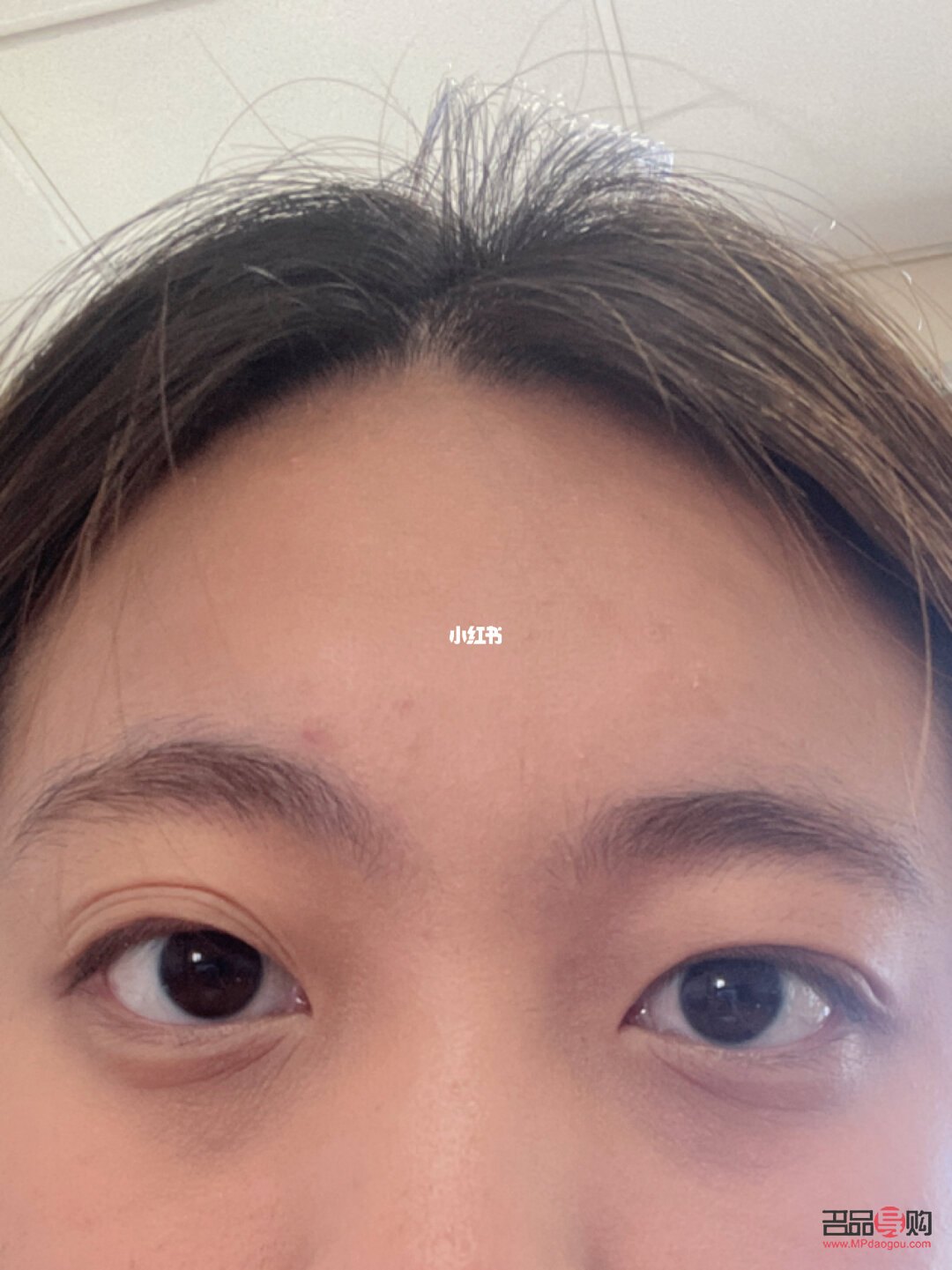 三眼皮怎么變回雙眼皮(三眼皮怎么變回雙眼皮學生)