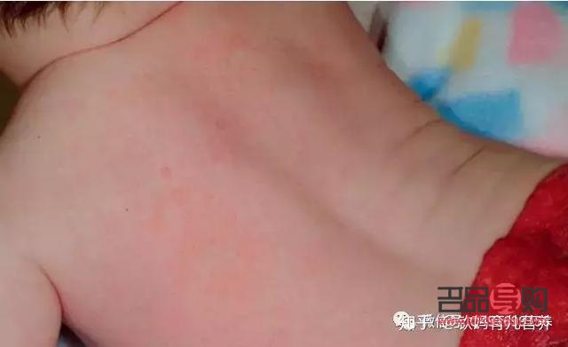 熱疹護理全攻略：守護肌膚健康，遠離熱疹困擾