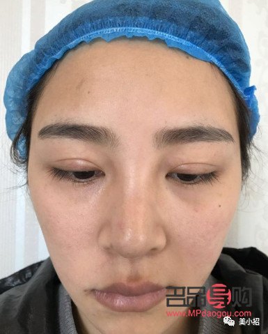 <h3>雙眼皮割窄了如何修復？專業指導與解決方案</h3>