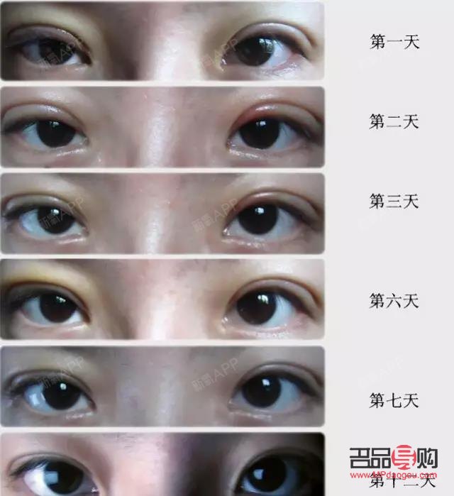 <h3>雙眼皮割窄了如何修復？專業指導與解決方案</h3>