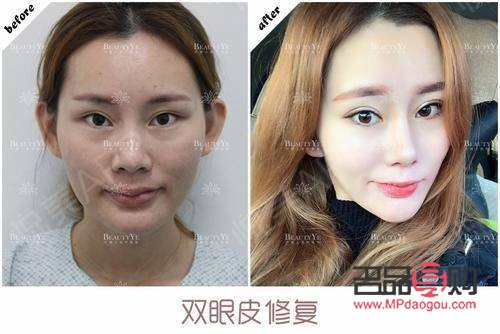雙眼皮割窄了如何修復？專業指導與解決方案