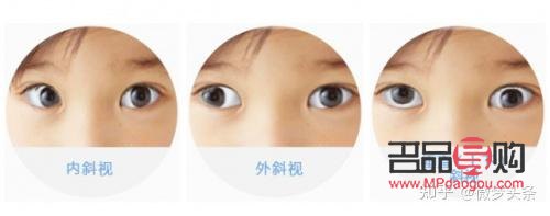 眼球偏移可以矯正嗎(眼球偏移可以矯正嗎多少錢)