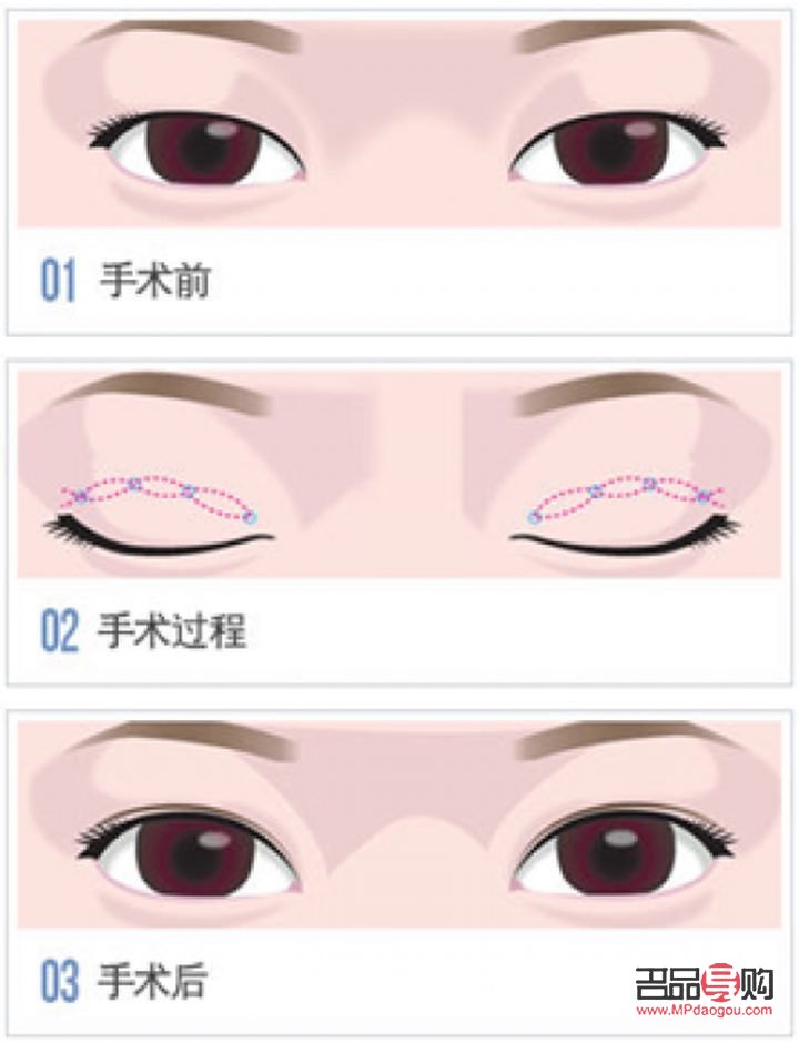 雙眼皮手術推薦(雙眼皮手術推薦醫院)