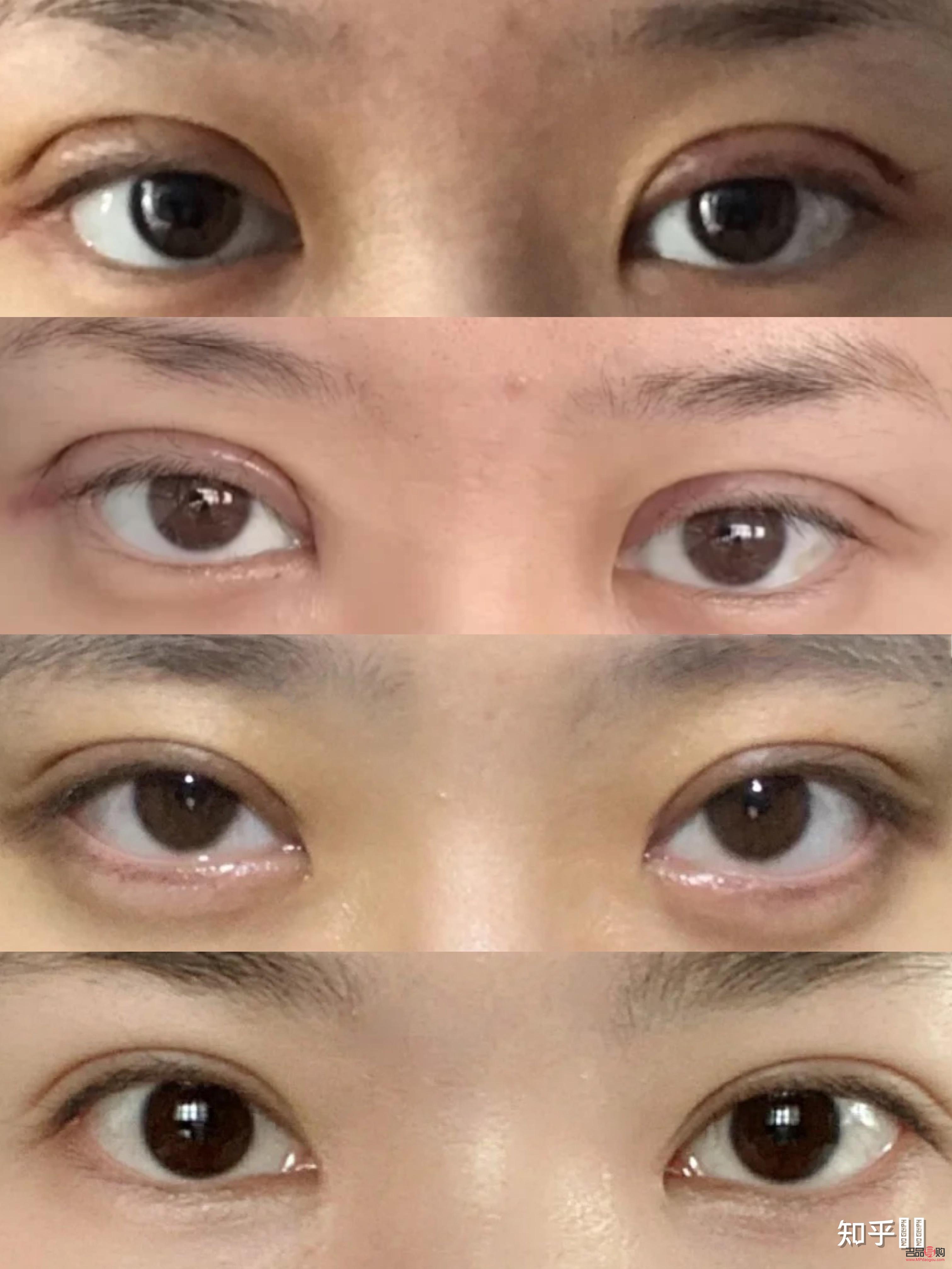 雙眼皮手術推薦(雙眼皮手術推薦醫院)