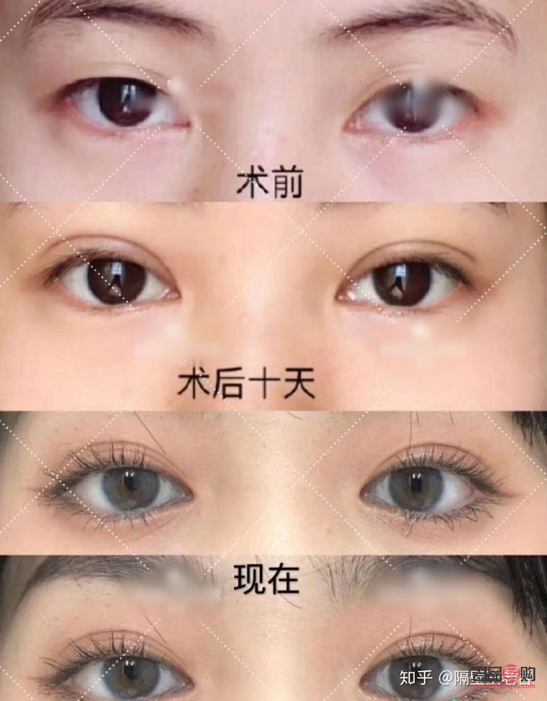 雙眼皮手術推薦(雙眼皮手術推薦醫院)