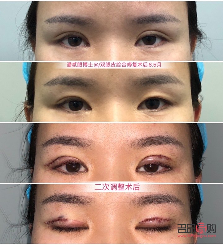 雙眼皮眼皮外翻會好嗎(雙眼皮外翻怎么辦)