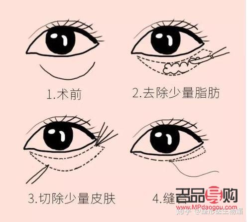 眼綜合(眼綜合手術包括什么項目)