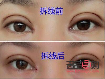 全切雙眼皮恢復之路：時間與自然的完美融合