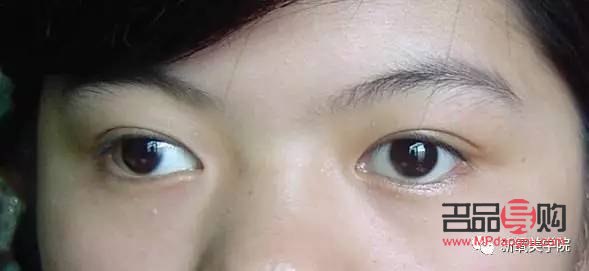 一只眼睛眼珠歪了：原因、影響與解決方案