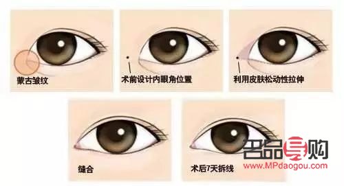 開(kāi)外眼角手術(shù)前后驚艷對(duì)比
