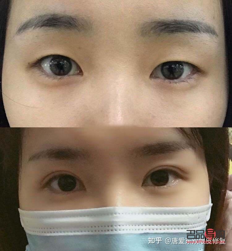 腫眼泡應該怎么改善(腫眼泡怎么改善啊)