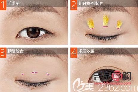 雙眼皮美容價格(雙眼皮美容價格表圖片)