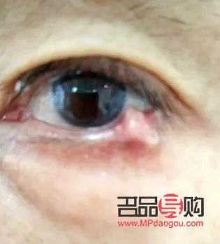 探索下眼瞼紋去除之道，重拾眼部青春魅力