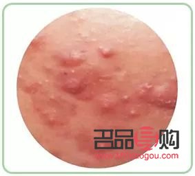 身體火燒怎么護理(身體火燒怎么護理最好)