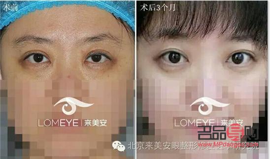 雙眼皮一邊寬一邊窄怎么修復好(雙眼皮一邊寬一邊窄怎么修復好呢)