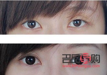 <h3>雙眼皮翹睫手術(shù)：綻放雙眼魅力，實(shí)現(xiàn)自然美眸</h3>