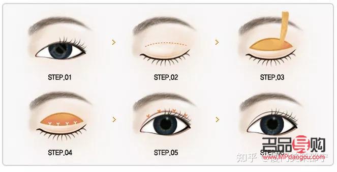 單眼皮變雙眼皮秘籍：非手術方法大揭秘
