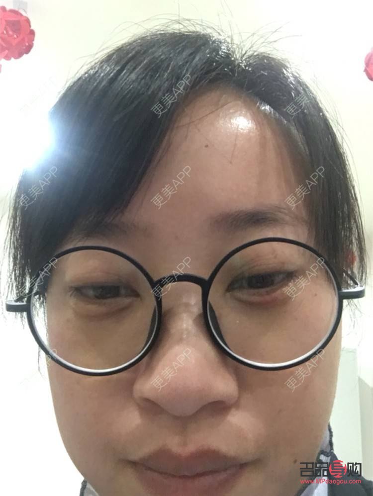 <h3>眼袋能徹底去除嗎？</h3>