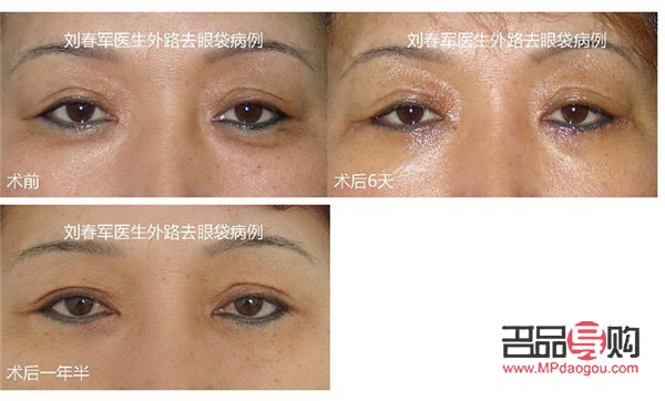 眼袋手術后的增生一般都能消失嗎(眼袋手術后的增生一般都能消失嗎圖片)