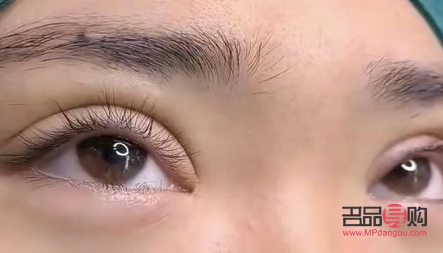 雙眼皮翹睫術前后圖片(翹睫術是怎么做的)
