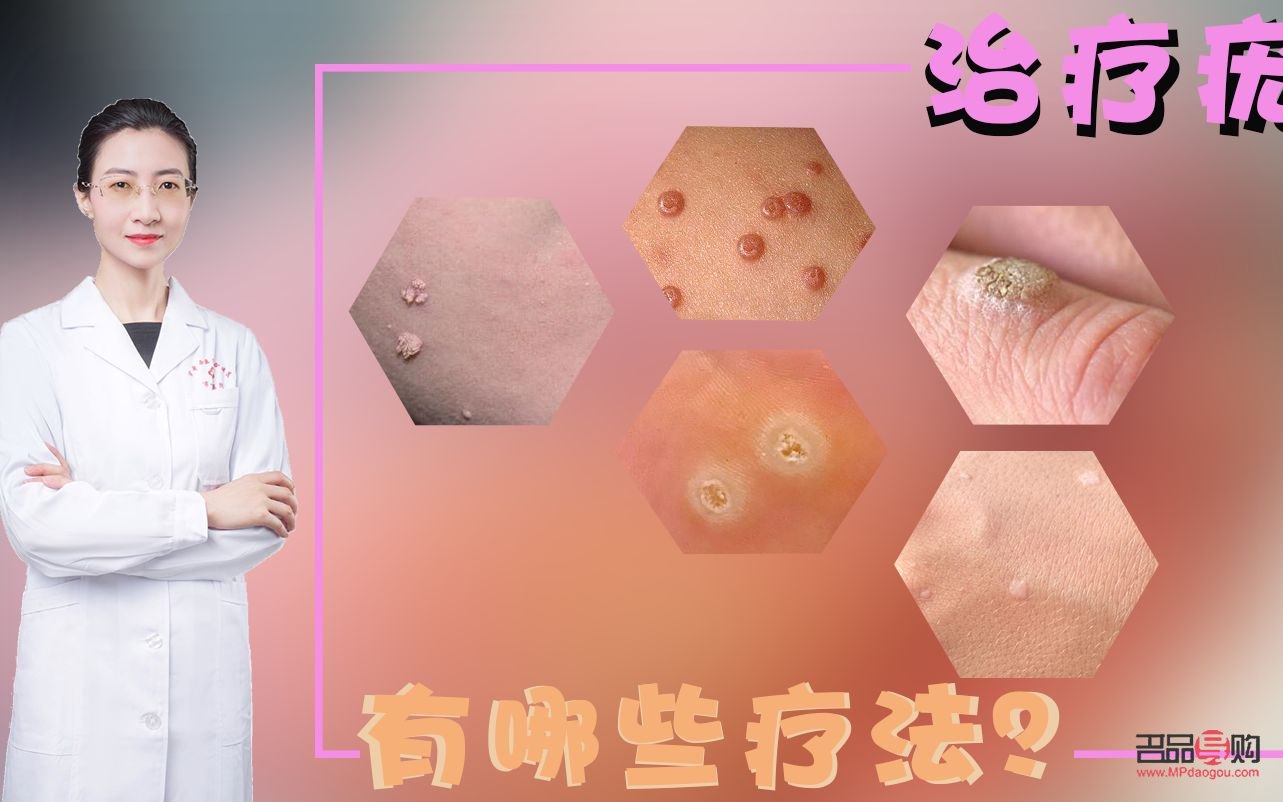 長疣怎么身體護理