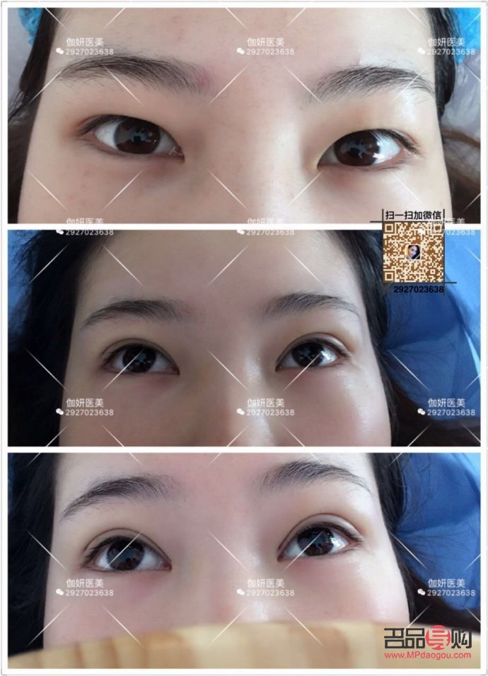 韓國(guó)納米無(wú)痕雙眼皮是什么技術(shù)(韓國(guó)納米無(wú)痕雙眼皮介紹)