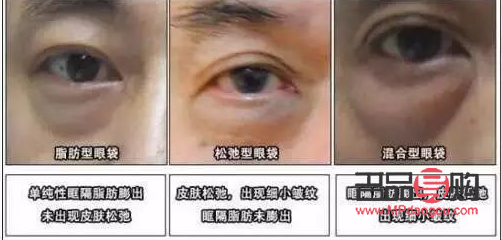 臥蠶與眼袋：你真的能分清嗎？