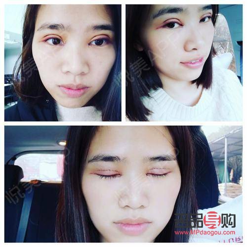 割雙眼皮后多久恢復自然(割雙眼皮后多久恢復自然一點)