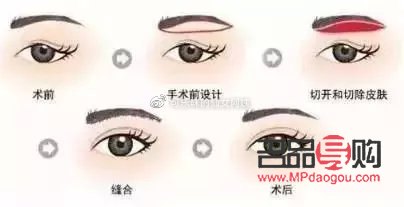 睜眼需要抬眉毛(睜眼需要抬眉毛一定得提肌嗎)