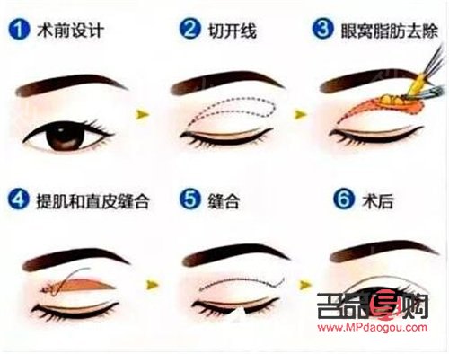 做雙眼皮手術多少錢(西南醫院做雙眼皮手術多少錢)