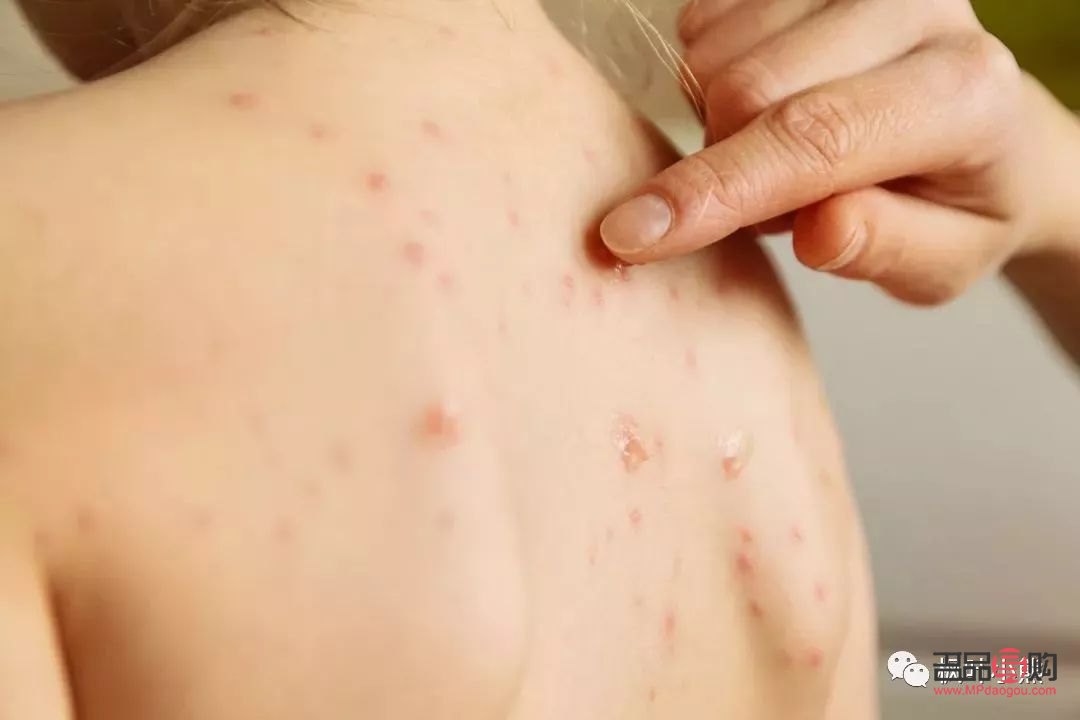 生水痘后如何護理身體(生水痘后如何護理身體好)
