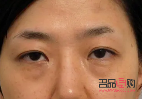 切眼袋后注意事項(去眼袋手術警惕三大后遺癥)