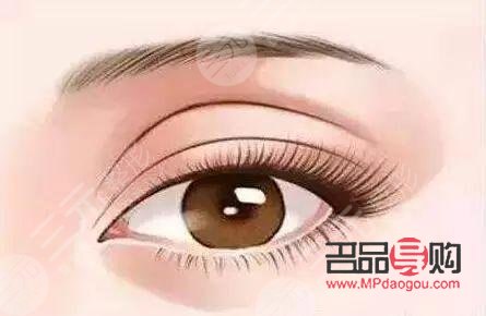 眼角下垂手術大概得多少錢(做雙眼皮手術要多久才能恢復好)