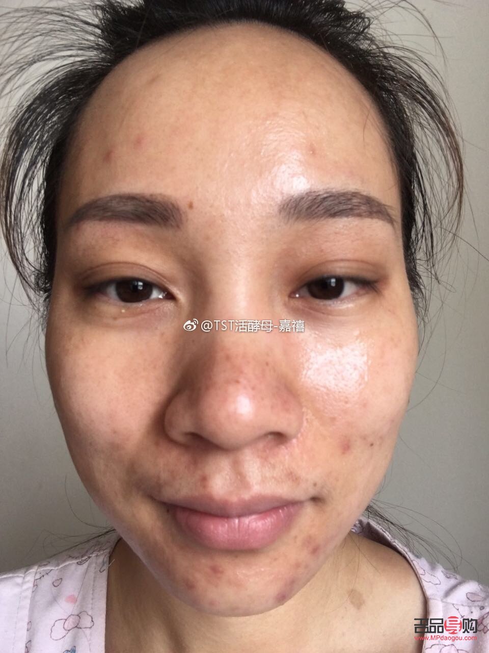 <h3>痘痘彩妝遮蓋術，重拾肌膚自信</h3>