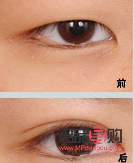 割雙眼皮30天恢復圖真實記錄